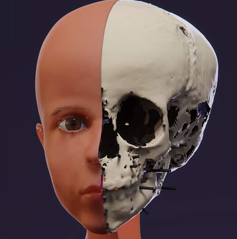 La prima ricostruzione del viso di un bambino in 3D